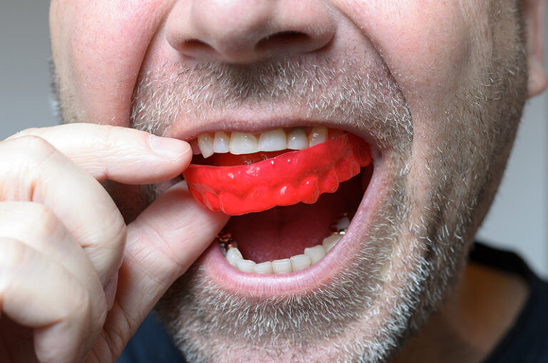 mouth-guards-in-airdrie-for-bruxism-