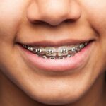Teeth Alignment for missing teeth
