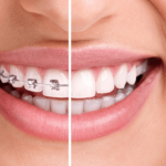 bracing for change why you should consider dental braces!